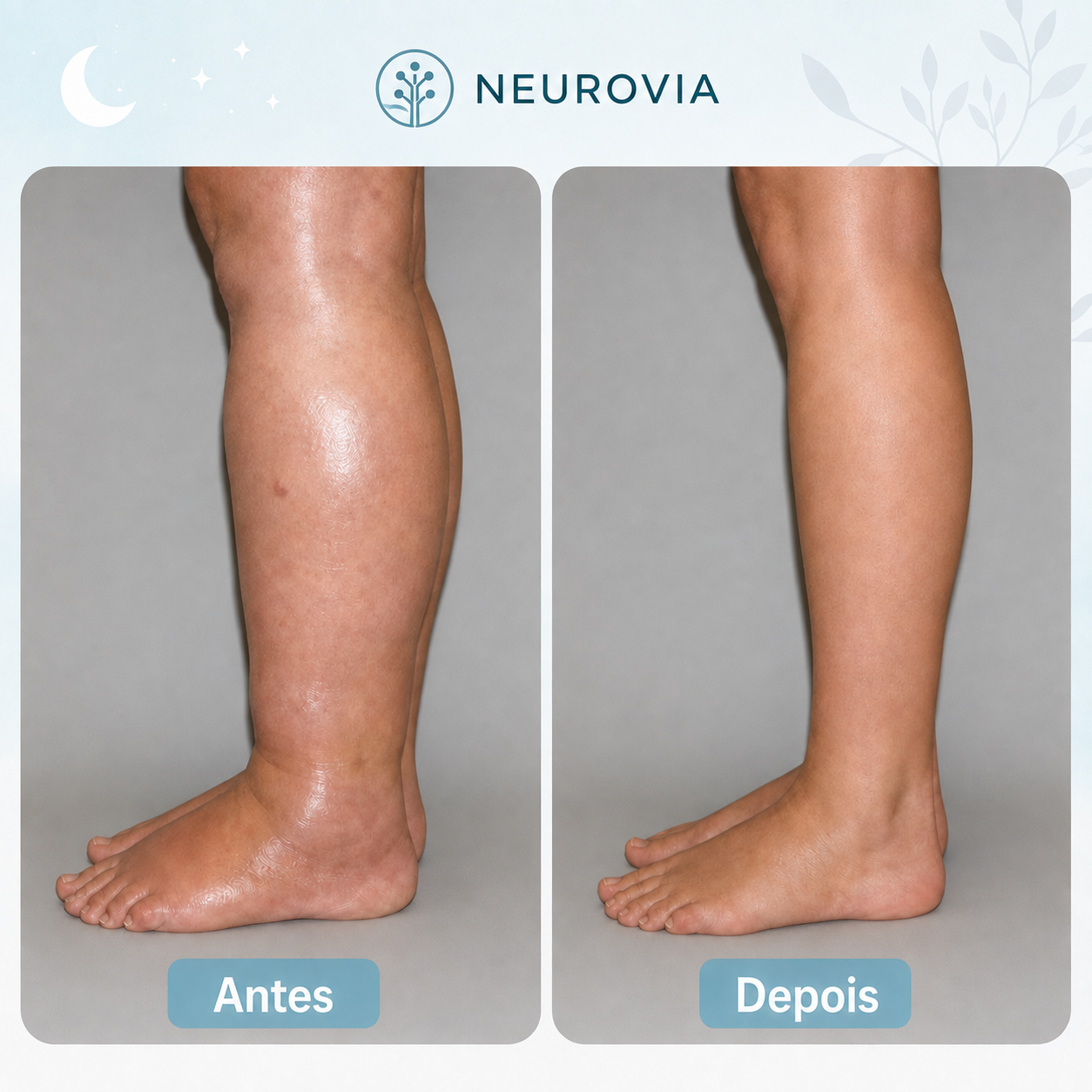 Neurovia™ Tratamento EMS Ativador para Pernas Inchadas, Pesadas ou Enfraquecidas — Para Uso em Casa